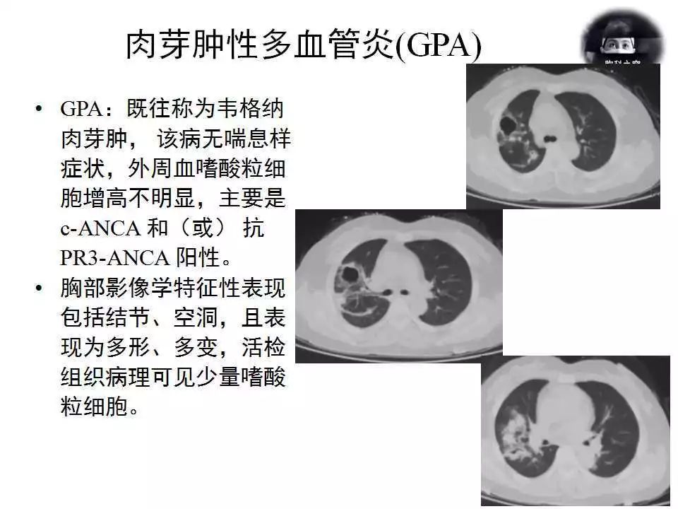 嗜酸性肉芽肿-嗜酸性肉芽肿是良性还是恶性