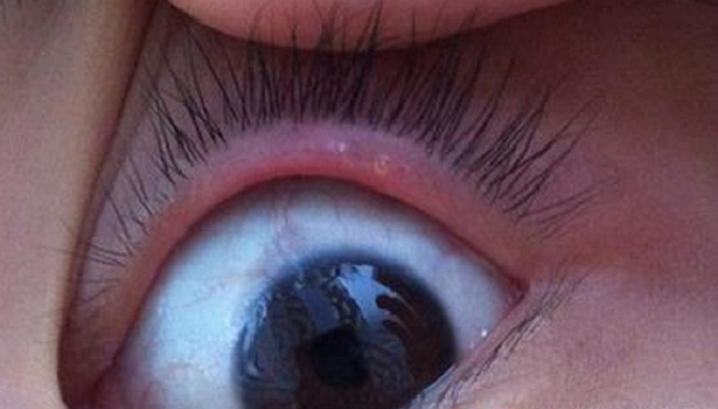 下眼睑麦粒肿-下眼睑内部长了个小疙瘩